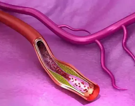 Farbige Illustration eines Blutgefäßes mit Querschnitt der Gefäßwände und atherosklerotischen Plaques