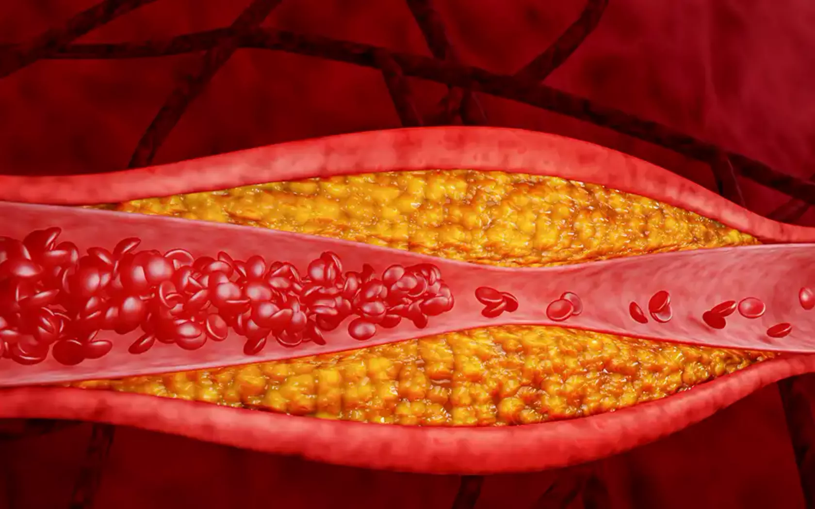 KI-Darstellung von einer mit Plaque verengten Arterie.