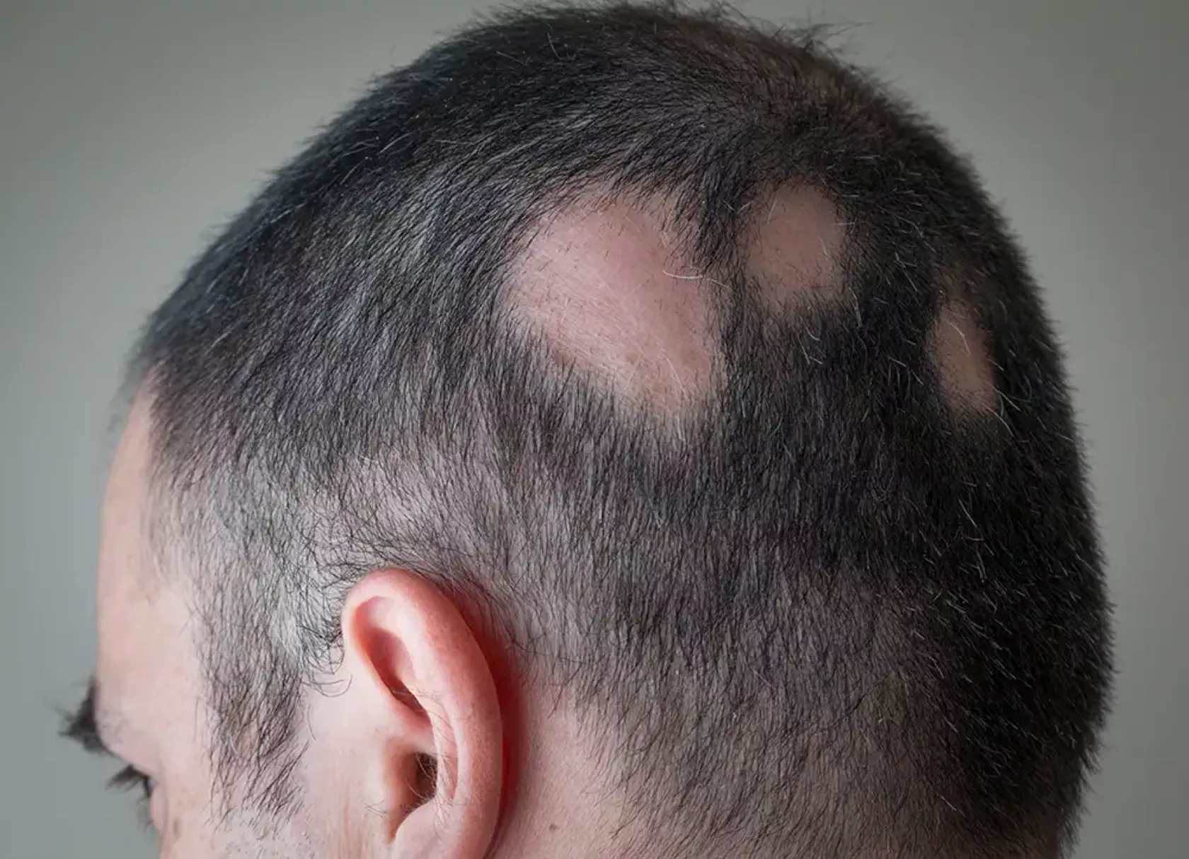 Hinterkopf eines kurzhaarigen Mannes mit drei runden kahlen Stellen - kreisrunder Haarausfall.