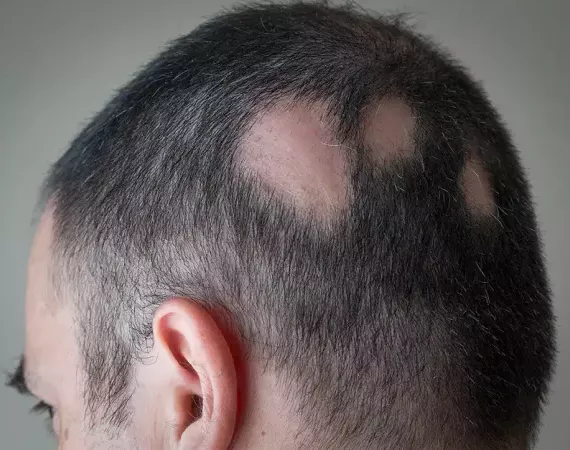 Hinterkopf eines kurzhaarigen Mannes mit drei runden kahlen Stellen - kreisrunder Haarausfall.